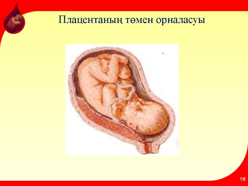 Плацентаның төмен орналасуы 18